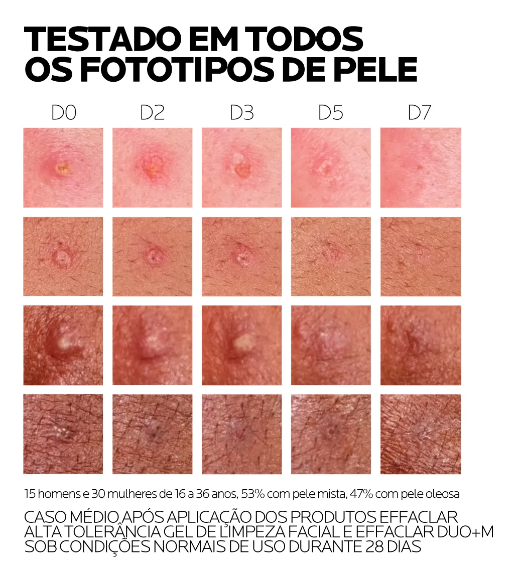 Imagem 7 de 10 de Creme Facial Antiacne Effaclar Duo+ M 40ml La Roche Posay