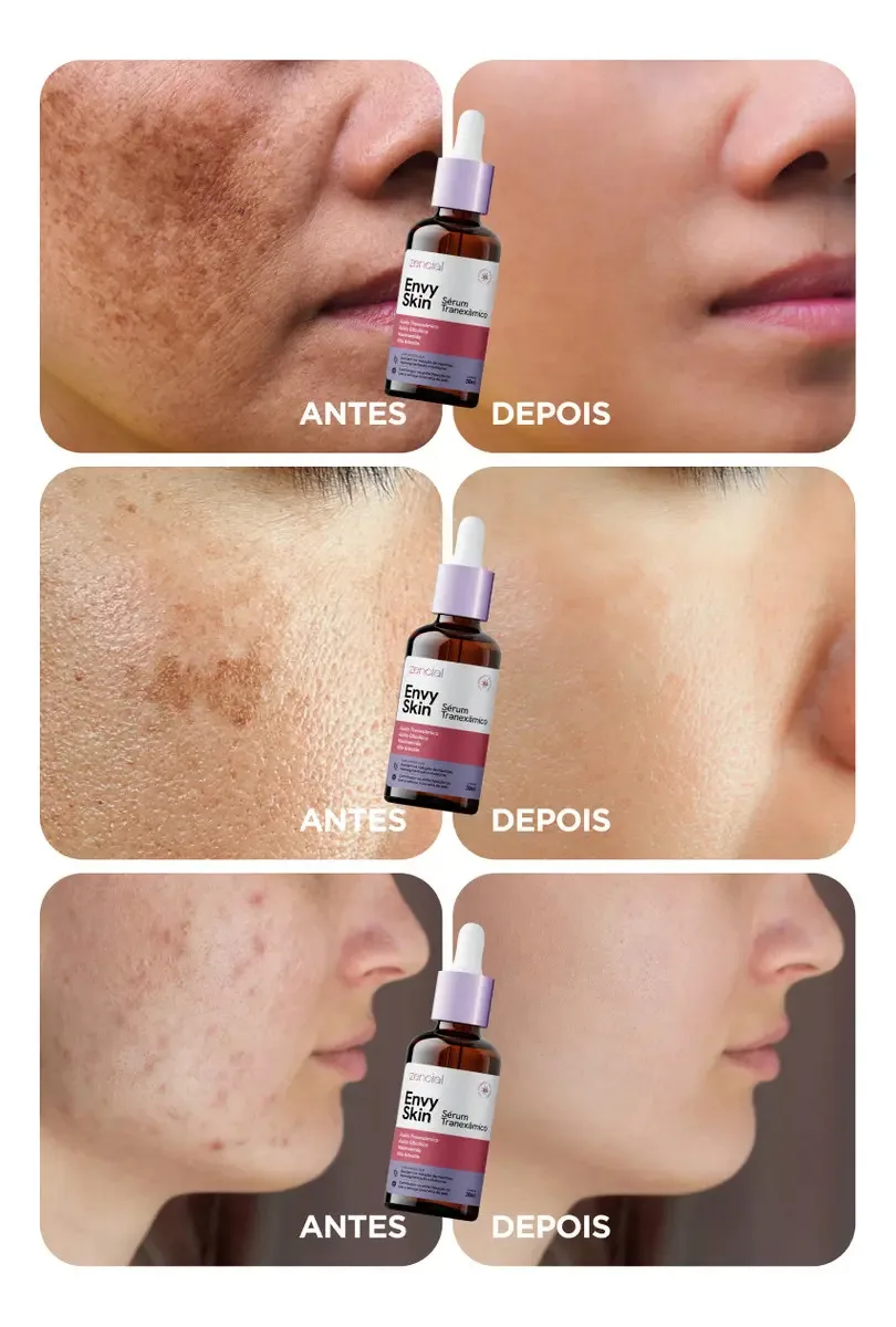 Sérum Envy Skin Ácido Tranexâmico Clareador Manchas e Melasma Profundo 30 mL Zencial